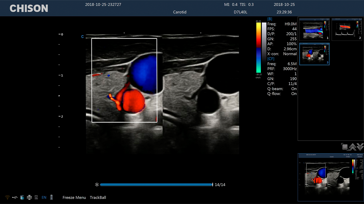 CBit 4 Carotid BBC